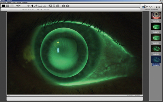 Imagen de fluoresceína verde de un ojo en una pantalla.